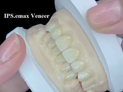 IPS.emax Veneer Premium Esthetische Oplossing Voor Verbazingwekkende Glimlach Transformaties