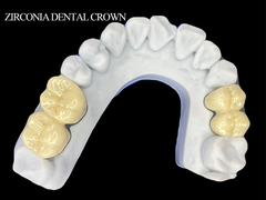 Zirconia tandkronen voor kiezen