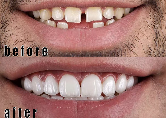 De laatste bedrijfszaken over Porselein veneers case 3