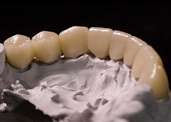 kopen Porselein gesmolten met metalen kronen - Geavanceerde technologie voor langdurige glimlachherstel online manufacture
