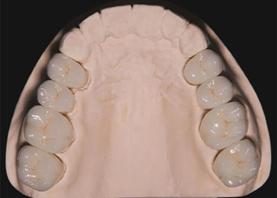 kopen Tandherstel Tanden Zirconia tandkronen gemaakt door China tandheelkundig laboratorium online manufacture