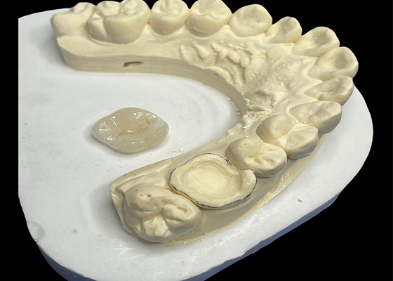 kopen Keramische tandheelkundige inlay Onlay voor effectieve tandreparatie met duurzame en esthetische porseleinoplossingen voor langdurige restauratie online manufacture