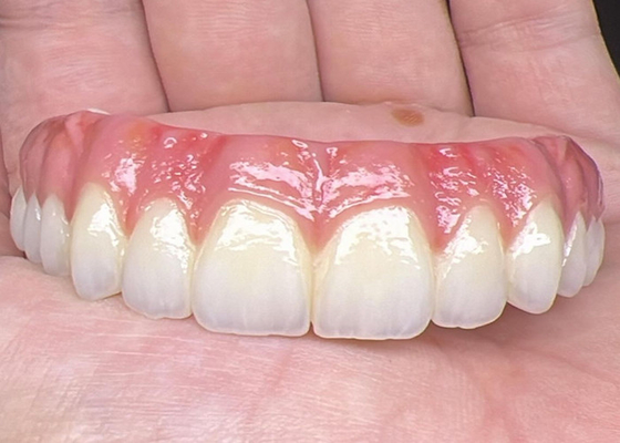 kopen Mondgezondheid Tandheelkundige implantaten Ondersteunde prothesen Brug Gepolijst oppervlak Ondersteunende volledige prothesen online manufacture