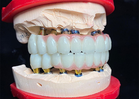 kopen Gepolijste Titaniumbasis tandheelkundige implantaten Keramische kroonbrug voor tandheelkundige restauratie online manufacture