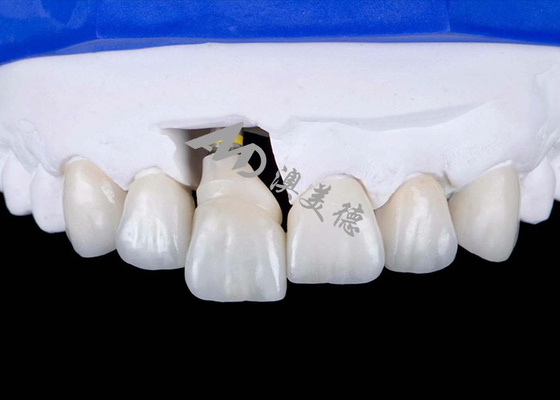 kopen Tandheelkundige kroon met een titanium onderstel voor een natuurlijke glimlach online manufacture