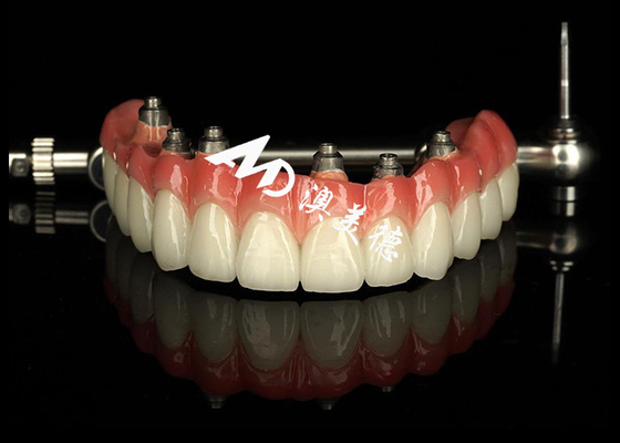 kopen Gepersonaliseerde tandheelkundige implantaten ondersteunde prothesen Crown Bridge Voor ontbrekende tanden Onderhoud online manufacture