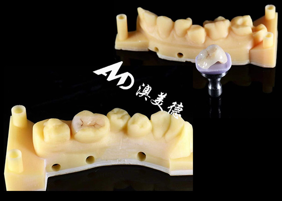 kopen Smooth Hypoallergenic Ceramic Inlays Onlays Custom Fit Vlekbestendigheid Hoge duurzaamheid online manufacture