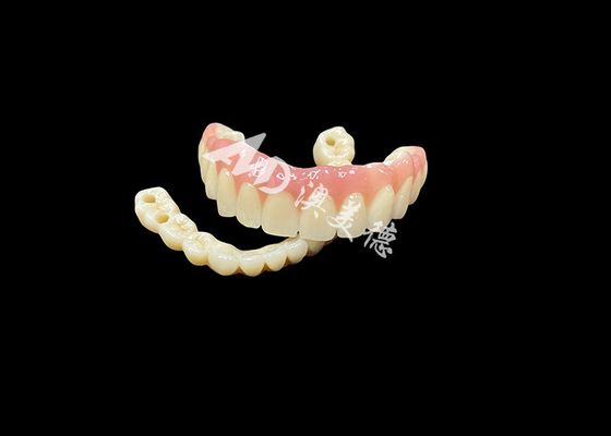 kopen Implantaten ondersteunde prothesen brug De ultieme tandheelkundige oplossing voor ontbrekende tanden online manufacture