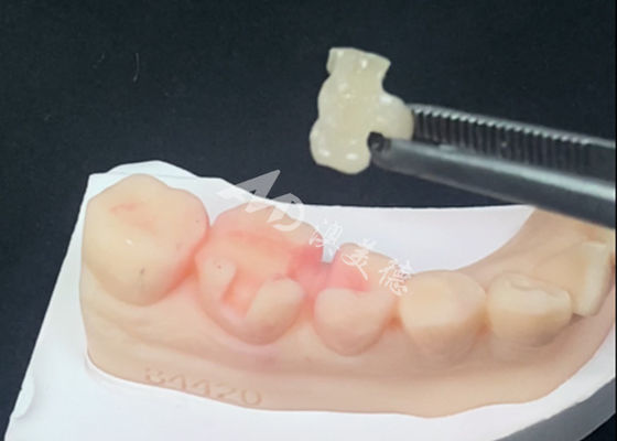 kopen Emax Ceramic Inlays Onlays Tandherstel voor natuurlijke tandkleur online manufacture