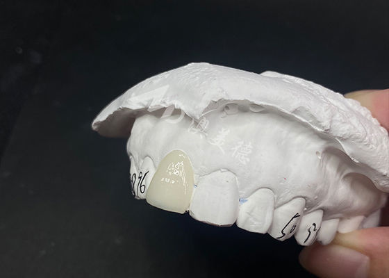Goede prijs Doorzichtige aangepaste tandheelkundige veneers snelle en effectieve oplossingen voor een blijvende glimlach online