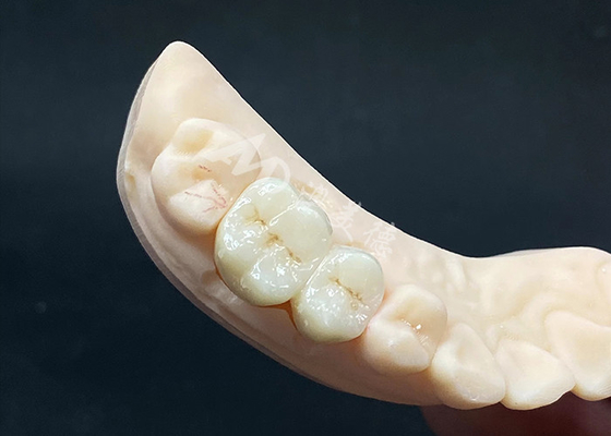 kopen Hoge doorschijnendheid Zirconia kroon Natuurlijk uitziend ontwerp met scheurbestand online manufacture