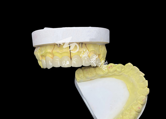 kopen Bereik een perfecte glimlach met keramische tandkronen van hoge kwaliteit voor een natuurlijke uitstraling en duurzame sterkte online manufacture