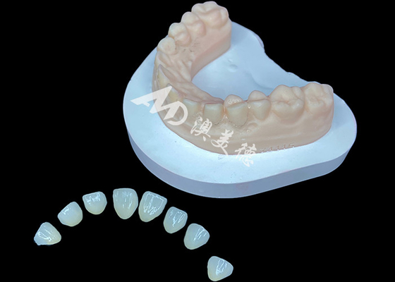 kopen IPS e.max Veneer Premium esthetische oplossing voor prachtige glimlachtransformaties online manufacture