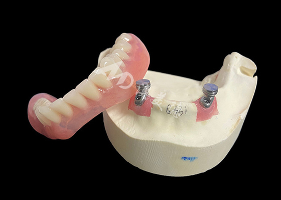 kopen Implantat Locator Bar Overdenture Solution voor verbeterd kauwen en spreken online manufacture