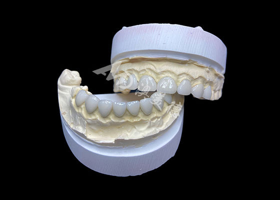 kopen Aanpassing Ultra dun glas keramische fineer hoge doorschijnendheid voor een natuurlijke glimlach online manufacture