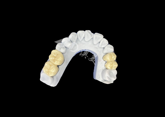 kopen Zirconia PFZ porseleinen tandkronijn van professioneel China tandheelkundig lab online manufacture