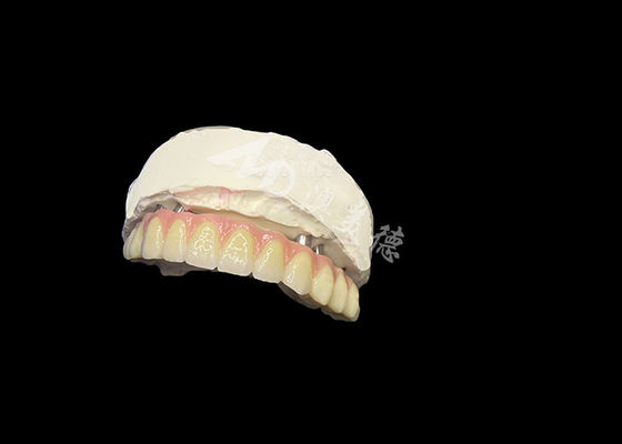 kopen Implantaten ondersteunde tandheelkundige prothesen Stabiliteit Comfort en een natuurlijke glimlach online manufacture