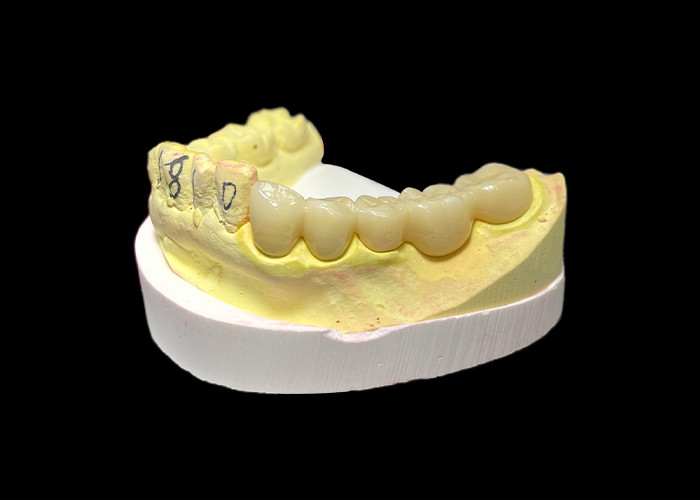 Premium Zirconia porseleinen tandkronen ongeëvenaarde sterkte Precisie pasvorm en uitzonderlijke esthetiek en duurzaamheid