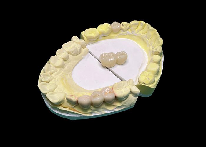 Advanced Translucency Ceramic Crowns and Bridges Enhance Your Smile with Precision and Natural Aesthetics for Long-lasting Durability (Geavanceerde doorzichtige keramische kronen en bruggen verbeteren je glimlach met precisie en natuurlijke esthetiek voor langdurige duurzaamheid)