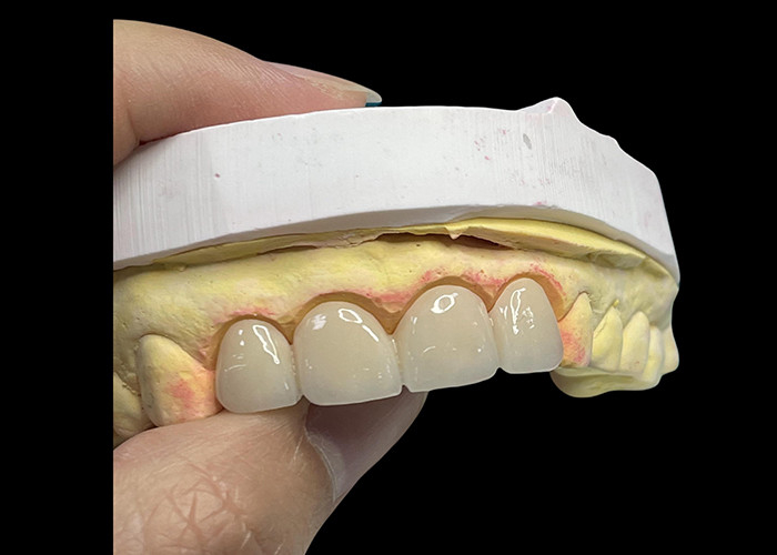 Advanced Translucency Ceramic Crowns and Bridges Enhance Your Smile with Precision and Natural Aesthetics for Long-lasting Durability (Geavanceerde doorzichtige keramische kronen en bruggen verbeteren je glimlach met precisie en natuurlijke esthetiek voor langdurige duurzaamheid)