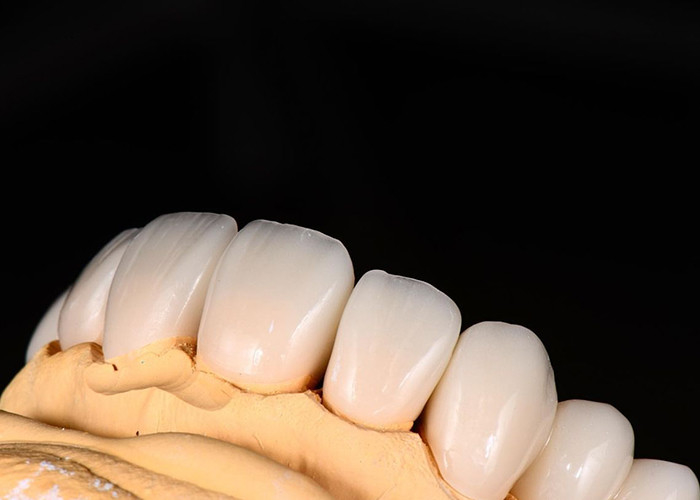 Advanced Translucency Ceramic Crowns and Bridges Enhance Your Smile with Precision and Natural Aesthetics for Long-lasting Durability (Geavanceerde doorzichtige keramische kronen en bruggen verbeteren je glimlach met precisie en natuurlijke esthetiek voor langdurige duurzaamheid)