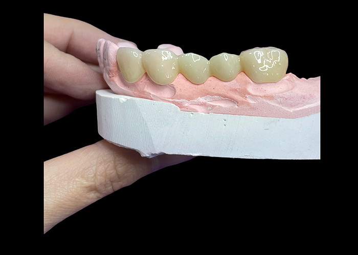 Alle keramische kronen en bruggen zijn ontworpen voor superieure esthetiek, duurzaamheid en natuurlijke pasvorm voor langdurig vertrouwen.