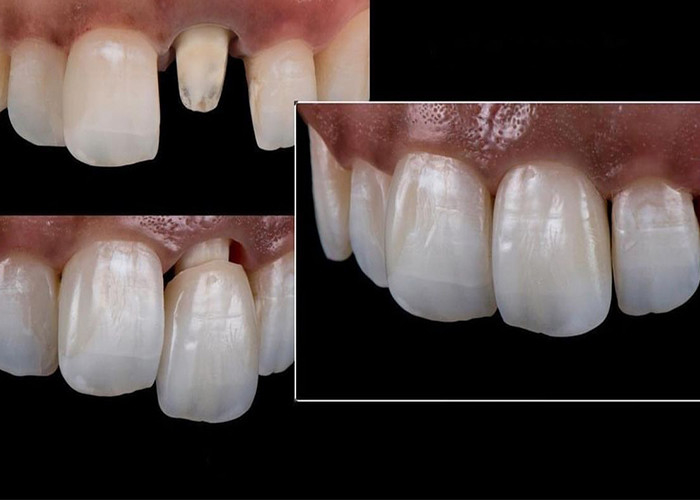 Alle keramische kronen en bruggen zijn ontworpen voor superieure esthetiek, duurzaamheid en natuurlijke pasvorm voor langdurig vertrouwen.