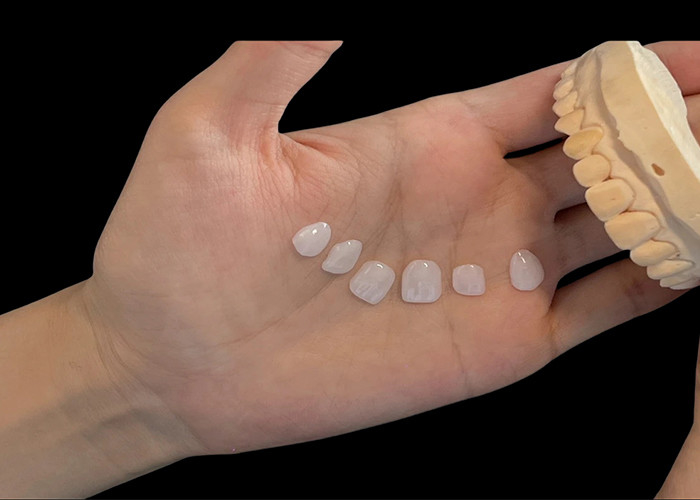 Porseleinen schaduw ultra dunne EMAX veneers vlekbestendig voor esthetische restauratie
