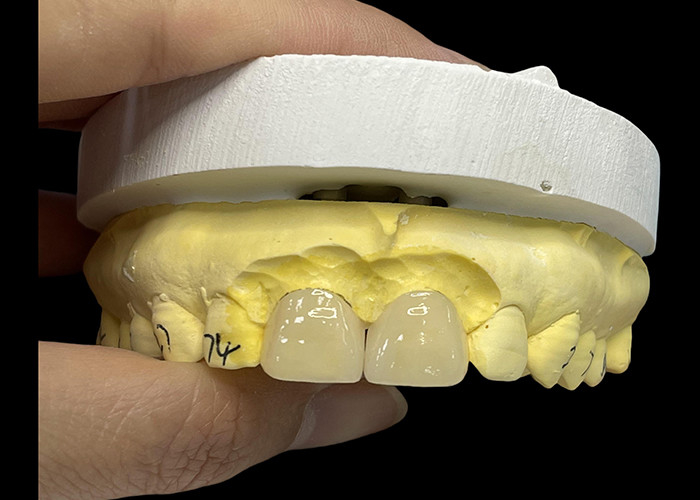 Porseleinen schaduw ultra dunne EMAX veneers vlekbestendig voor esthetische restauratie