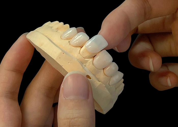 Porseleinen schaduw ultra dunne EMAX veneers vlekbestendig voor esthetische restauratie