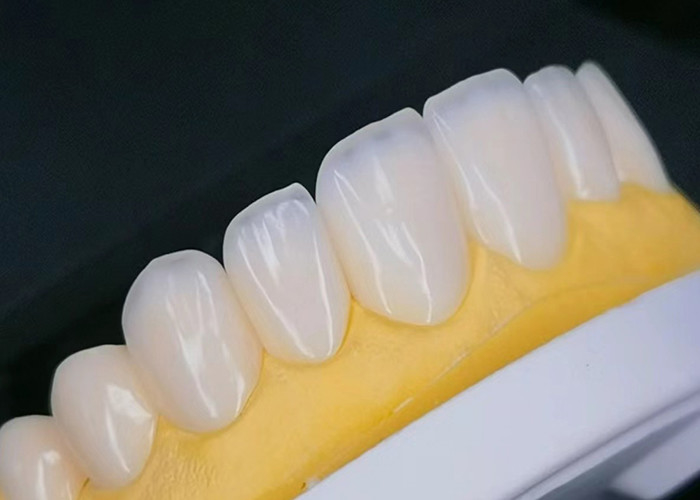 EMAX porselein fineer met vlekbestendigheid voor natuurlijk uitziende esthetische restauratie