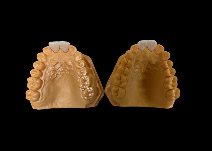 Aesthetische circonia tandkroon perfect geschikt voor voor- en achtertanden