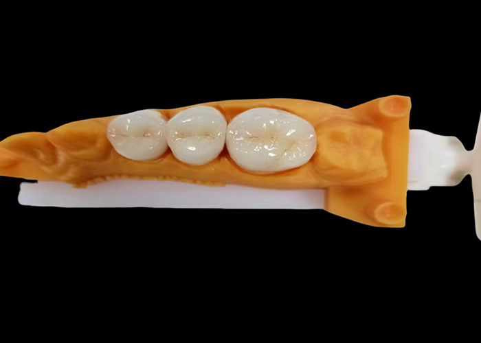 Versleten-bestendige circonia tandkroon met chips en vlekkenbestandheid en natuurlijke esthetiek uit China tandheelkundig lab