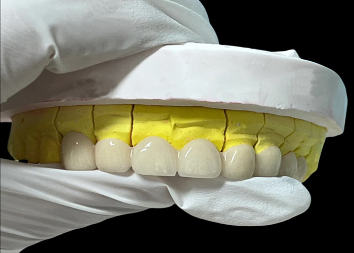 Zirconia porselein tandheelkundige kroon met esthetische en natuurlijke afwerking uit China tandheelkundig laboratorium