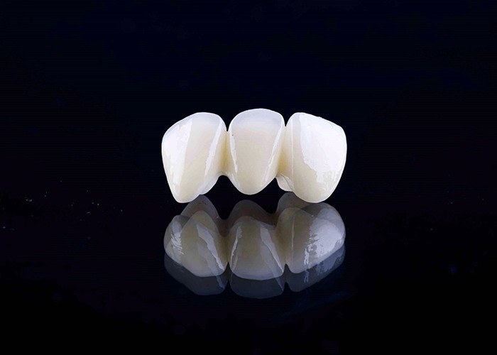 Zirconia porselein tandheelkundige kroon met esthetische en natuurlijke afwerking uit China tandheelkundig laboratorium