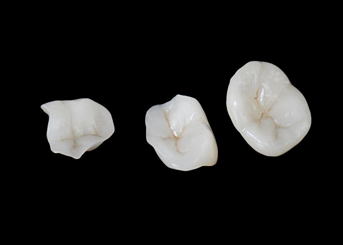 Biocompatibele keramische inlagen en onlays ontworpen voor comfortabele duurzaamheid en naadloze integratie met natuurlijke tanden