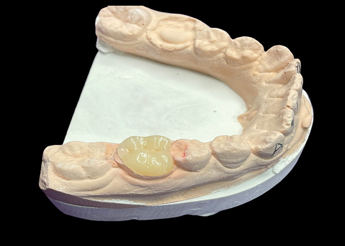 Custom Smooth Dental Ceramic Inlay voor kleurbestendige naadloze tandreparatie en natuurlijke esthetiek