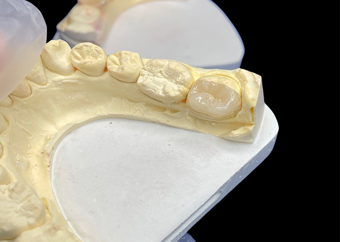 Custom Smooth Dental Ceramic Inlay voor kleurbestendige naadloze tandreparatie en natuurlijke esthetiek