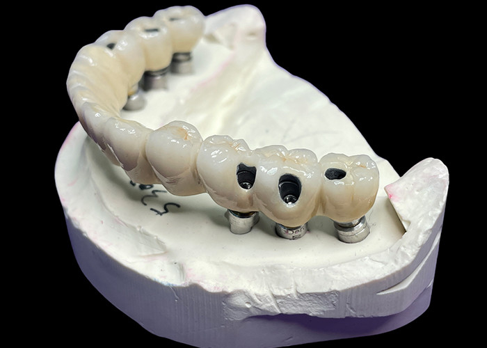 Full Arch Implantaten Kronen en bruggen Herstel van functie en esthetiek met geavanceerde oplossingen