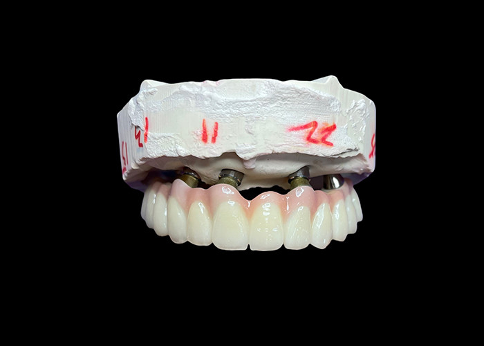 Tandheelkundige implantaten ondersteunde vaste volle gebit tandheelkunde voor een permanente, stabiele en natuurlijke oplossing voor ontbrekende tanden