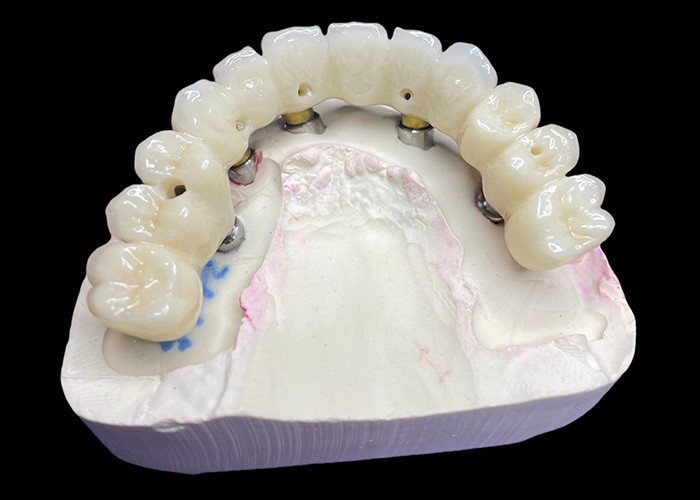 Full Arch Implantaten Kronen en bruggen Herstel van functie en esthetiek met geavanceerde oplossingen