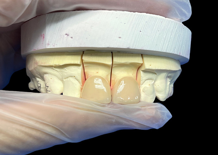 Precision Strength EMAX Porselein Finer Incisor voor natuurlijke uitziende esthetische restauratie