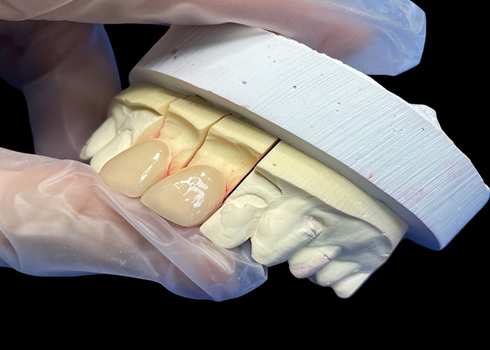 Precision Strength EMAX Porselein Finer Incisor voor natuurlijke uitziende esthetische restauratie