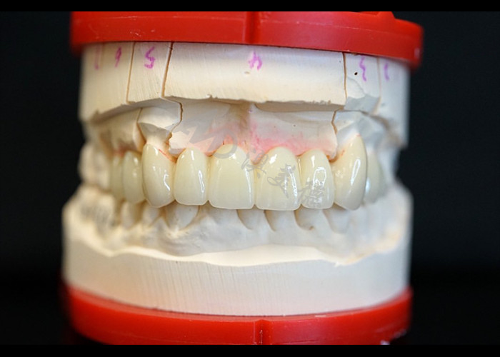 Sterkte Natuurlijke esthetiek Solid Zirconia kroon Perfect geschikt voor een of meerdere tanden