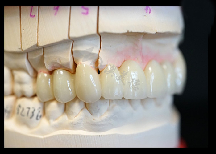Sterkte Natuurlijke esthetiek Solid Zirconia kroon Perfect geschikt voor een of meerdere tanden