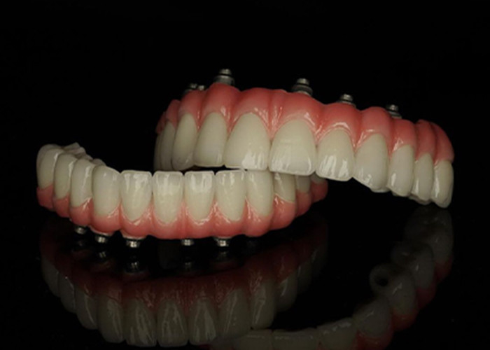 Titanium basis vaste implantaten ondersteunde prothesen met keramische kroon brug voor het vervangen van ontbrekende tanden