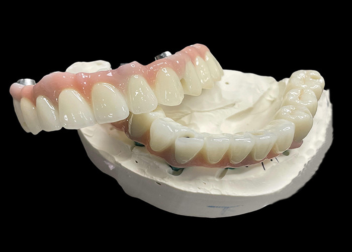 Titanium basis vaste implantaten ondersteunde prothesen met keramische kroon brug voor het vervangen van ontbrekende tanden