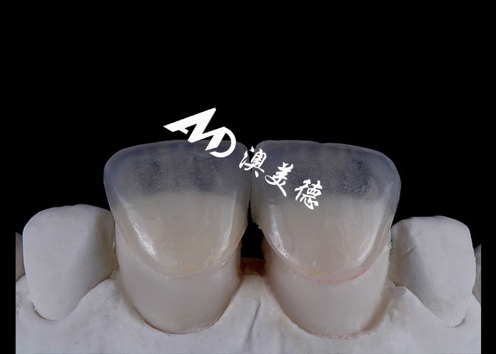Transformeer je glimlach met IPS emax Press Porselein veneers Sterkte Esthetiek en duurzaamheid gecombineerd