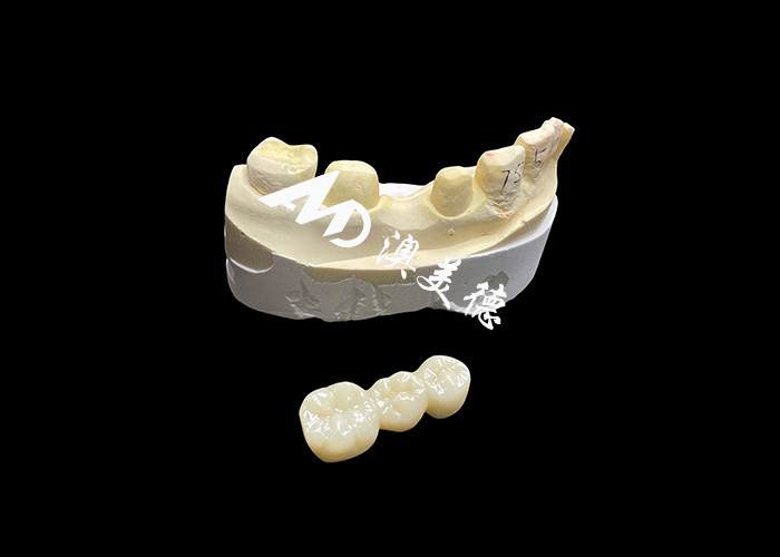 Hoge hardheid esthetische Zirconia tandkronijn met doorschijnendheid en scheurbestand van China tandheelkundig lab