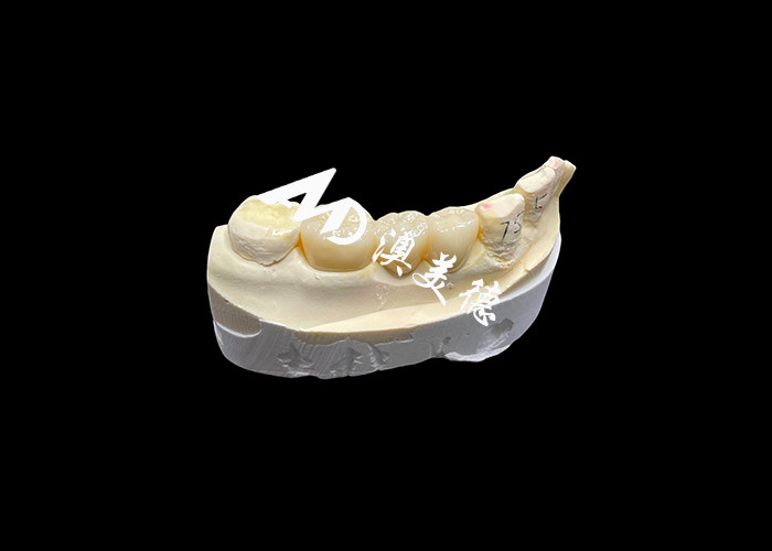 Hoge hardheid esthetische Zirconia tandkronijn met doorschijnendheid en scheurbestand van China tandheelkundig lab